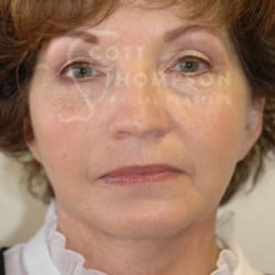 Facelift Before and After Photos | Utah Facial Plastics 286