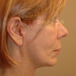 Facelift Before and After Photos | Utah Facial Plastics 289
