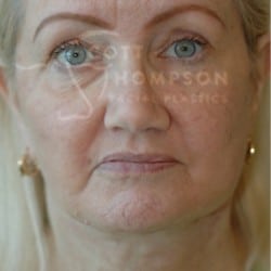 Facelift Before and After Photos | Utah Facial Plastics 292