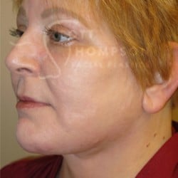 Facelift Before and After Photos | Utah Facial Plastics 293