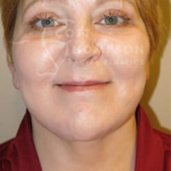 Facelift Before and After Photos | Utah Facial Plastics 293