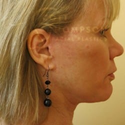 Facelift Before and After Photos | Utah Facial Plastics 301