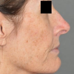 Co2 Laser Resurfacing by Dr. Thompson