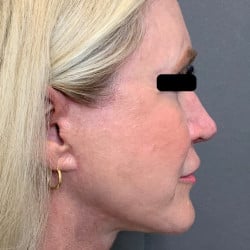 Facelift,  Periorbital Fat Injections, Dermabrasion, Upper & Lower Bleph by Dr. Thompson