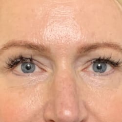 Lower Blepharoplasty and Periorbital Fat Injections by Dr. Thompson