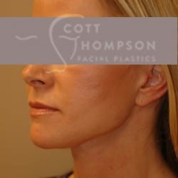 Facelift Before and After Photos | Utah Facial Plastics 307