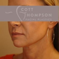 Facelift Before and After Photos | Utah Facial Plastics 307
