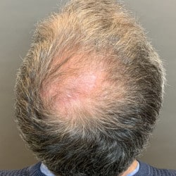 FUT Hair Transplant post Mohs Reconstruction by Dr. Thompson