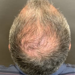 FUT Hair Transplant post Mohs Reconstruction by Dr. Thompson
