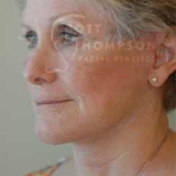 Facelift Before and After Photos | Utah Facial Plastics 310