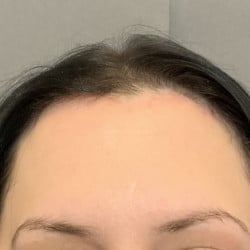 Forehead Reduction by Dr. Thompson