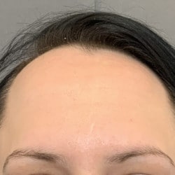 Forehead Reduction by Dr. Thompson