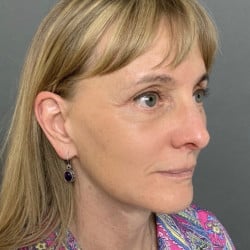 Facelift, Upper & Lower Blepharoplasty by Dr. Henstrom