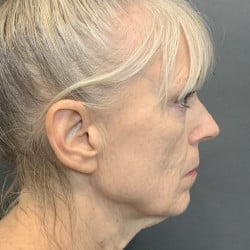 Facelift & Fat Transfer by Dr. Thompson