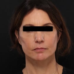 Facelift, Fat Injections, Upper & Lower Blepharoplasty by Dr. Thompson