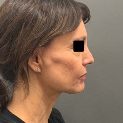Facelift, Fat Injections, Upper & Lower Blepharoplasty by Dr. Thompson