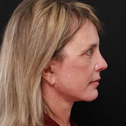 Facelift, Browlift, Fat Transfer, Lip Lift, Upper Blepharoplasty, and Skin Pinch by Dr. Thompson