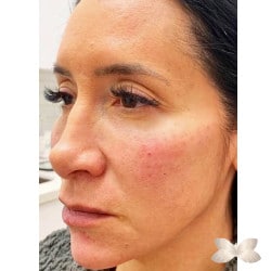 Corrección de rostro completo con relleno