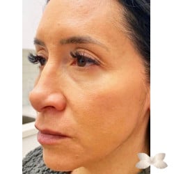 Corrección de rostro completo con relleno