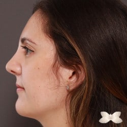 Rhinoplasty by Dr. Henstrom