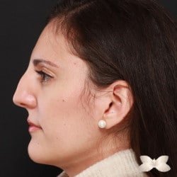 Rhinoplasty by Dr. Henstrom