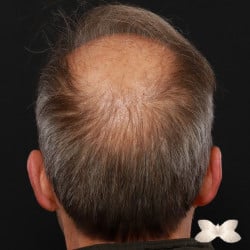 FUT Hair Transplant by Dr. Henstrom