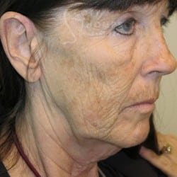 FACELIFT BEFORE & AFTER PHOTOS PATIENT 985
