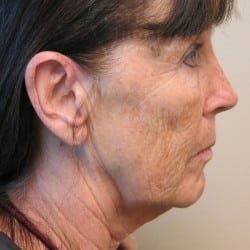 FACELIFT BEFORE & AFTER PHOTOS PATIENT 985