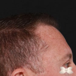 FUE Hair Transplant By Dr. Henstrom