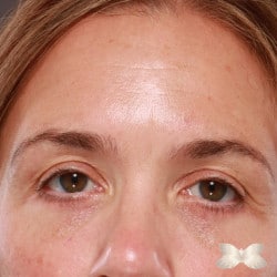 Lower Eyelid Lift by Dr. Henstrom