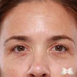 Lower Eyelid Lift by Dr. Henstrom