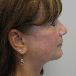 FACELIFT | IMPLANT | EYELIDS WITH FAT REPOSITIONING – 954
