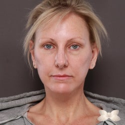 Browlift and Facelift by: Dr. Thompson