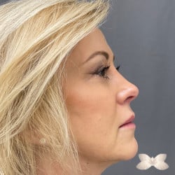 FaceTite, Upper and Lower Eyelid Lift by: Dr. Henstrom