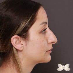 Chin Augmentation  with Submental Liposuction by: Dr. Henstrom
