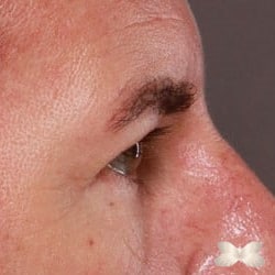 Lower Eyelid Lift by: Dr. Henstrom
