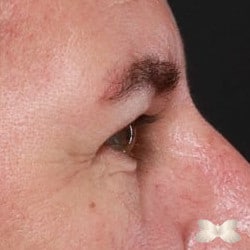 Lower Eyelid Lift by: Dr. Henstrom