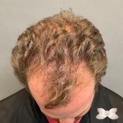 FUE Hair Transplant by: Dr. Thompson