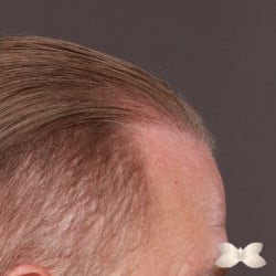 FUE Hair Transplant by: Dr. Thompson