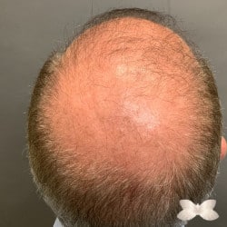 FUT Hair Transplant by: Dr. Thompson