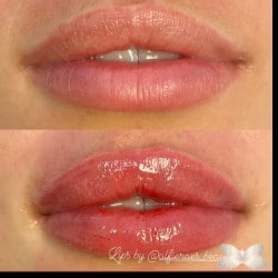 Lip Augmentation by: Alfie