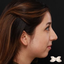 Rhinoplasty by: Dr. Thompson