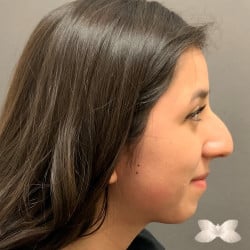 Rhinoplasty by: Dr. Thompson