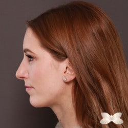 Chin Implant and Rhinoplasty by: Dr. Thompson