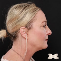 Facelift, Eyelid Lift and Fat Grafting by: Dr. Thompson