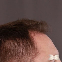 FUE Hair Transplant by: Dr. Henstrom