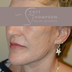 FACELIFT | FAT INJECTIONS | UPPER EYELID SURGERY | LOWER EYELID SURGERY WITH FAT REPOSITIONING | PERIORAL DERMABRASION – 901