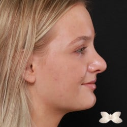 Rhinoplasty Revision by: Dr. Henstrom