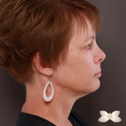 Facelift, Browlift, and Upper and Lower Eyelid Lift by: Dr. Thompson