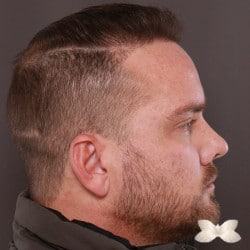 FUE Hair and Beard Transplant by: Dr. Thompson